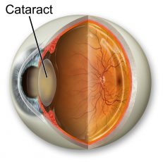 Eye Cataracts and Cataract Surgery