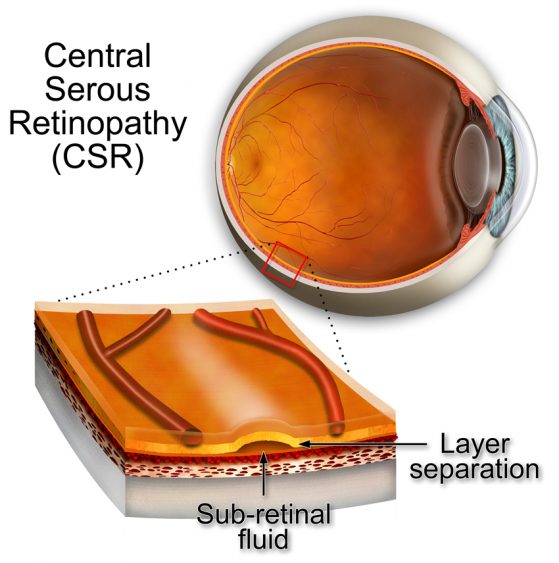 Central Serous Retinopathy (CSR) | Gold Coast | Eye Specialist Institute