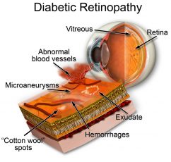Anatomy of Diabetic Retinopathy