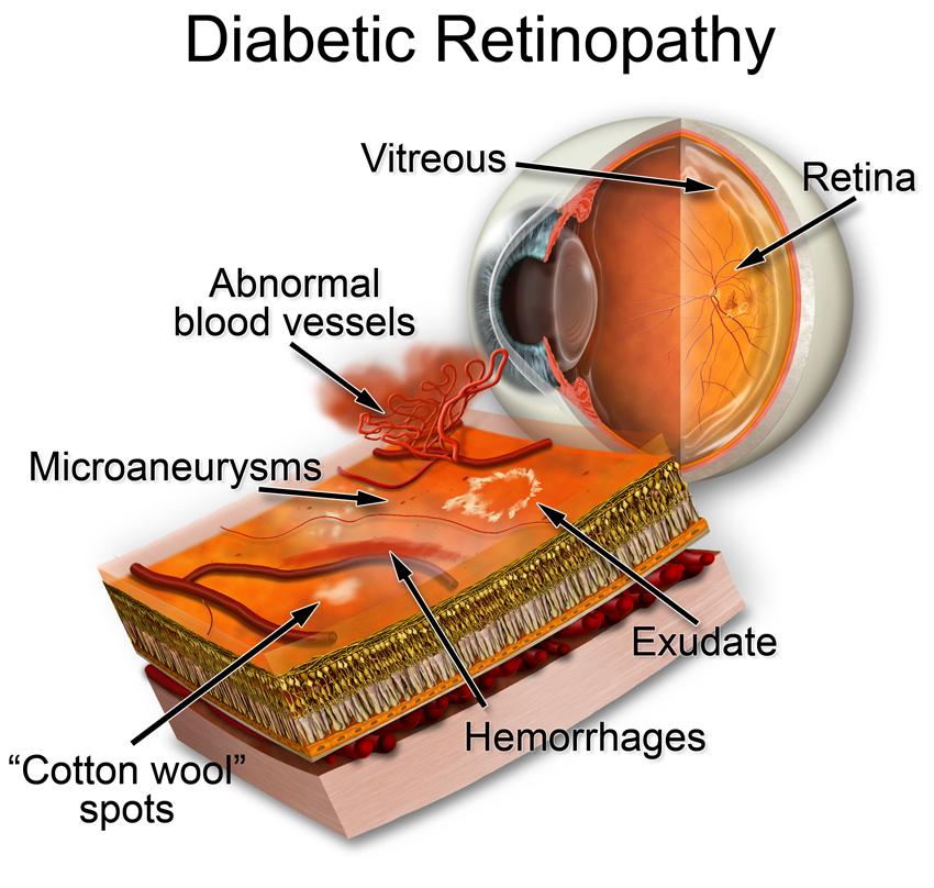 Retina Problems Common Retinal Problems | Eye Specialist Institute | Gold Coast Clinics
