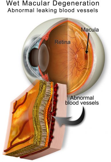 Age-Related Macular Degeneration