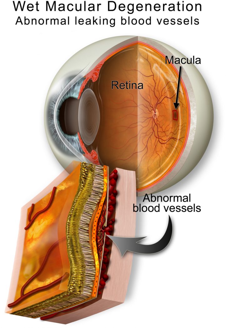 Macular Degeneration Treatment Gold Coast Eye Specialist Institute