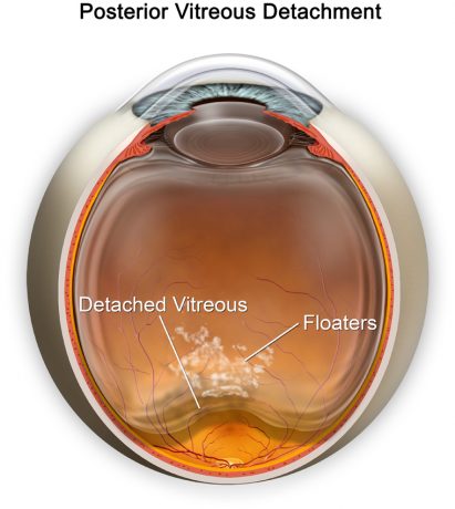 Anatomy of Posterior Vitreous Detachment