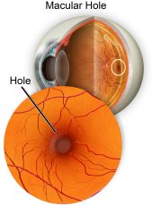 Anatomy of a macular hole.