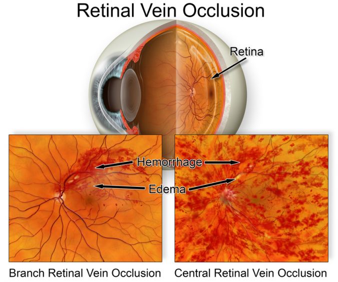 Retinal Vein Occlusion & Treatment Gold Coast Eye Specialist Institute