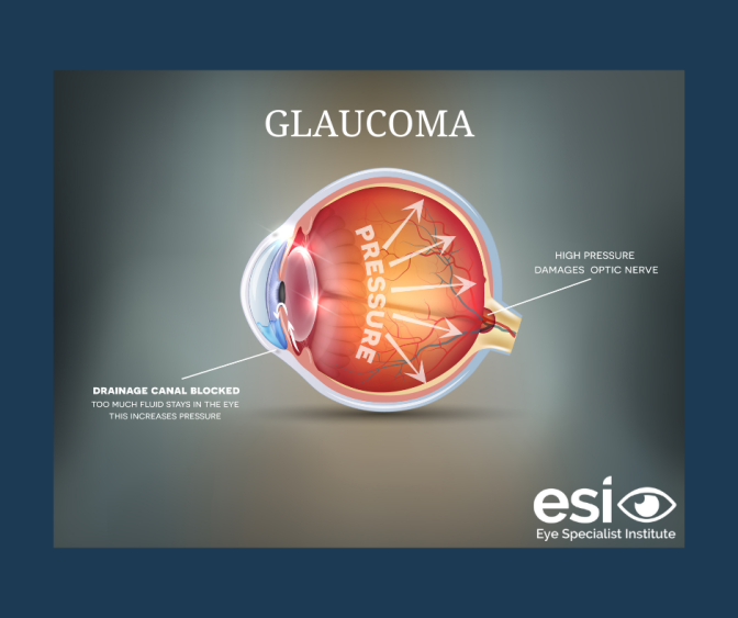 Glaucoma causes vision loss because of irreversible damage to the optic nerve, often due to raised intraocular pressure (IOP).