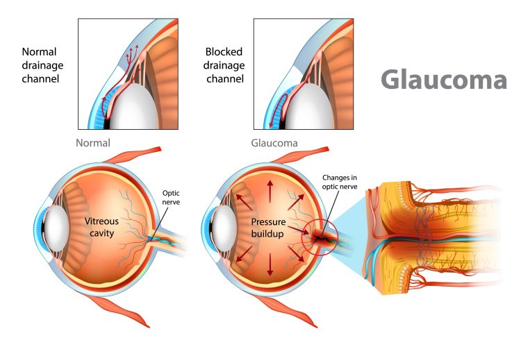 Glaucoma anatomy